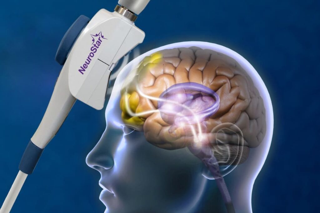 NeuroStar TMS coil delivers magnetic pulses to the brain, illustrating TMS therapy for depression vs medication approach.