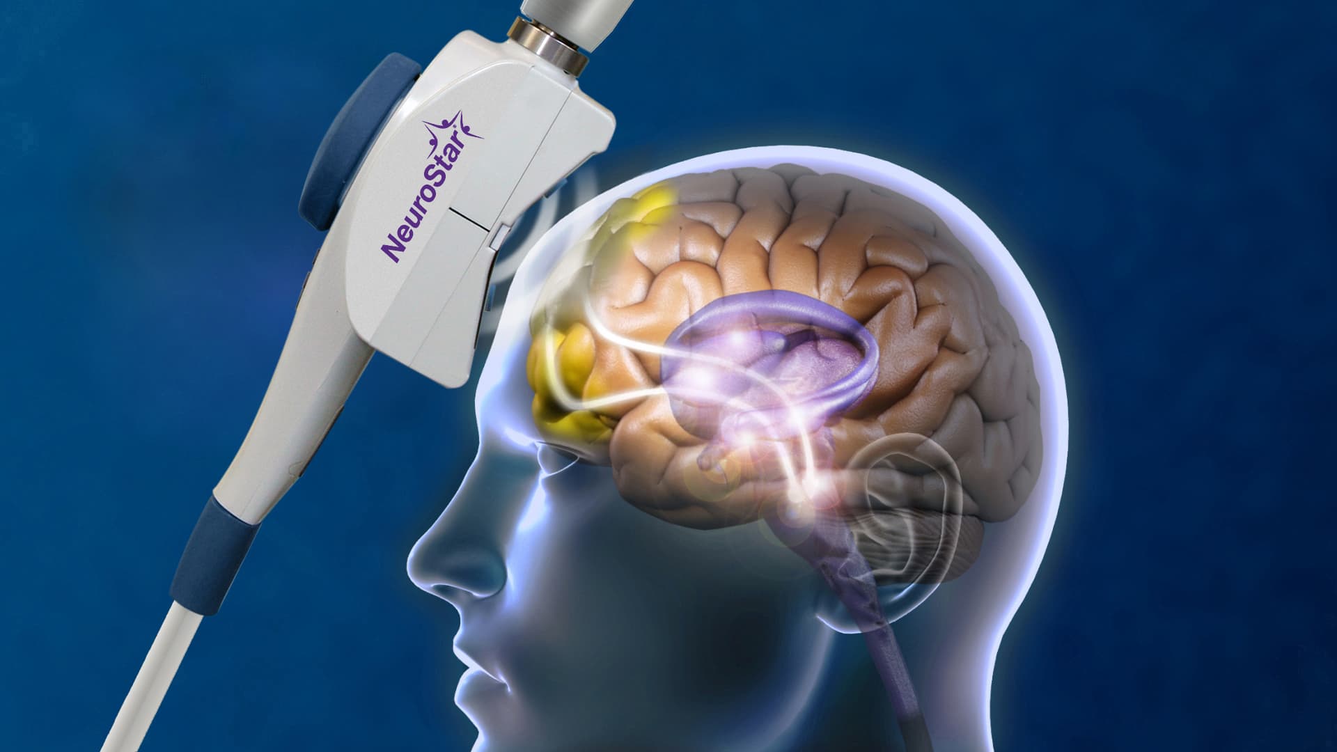 Illustration of a NeuroStar device targeting brain regions linked to motivation through magnetic stimulation